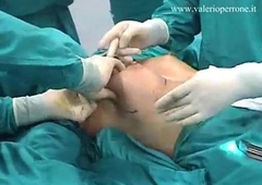 ,Breast Into the bargain transaxillary, prima e dopo, mastoplastica additiva per via ascellare - YouTube
